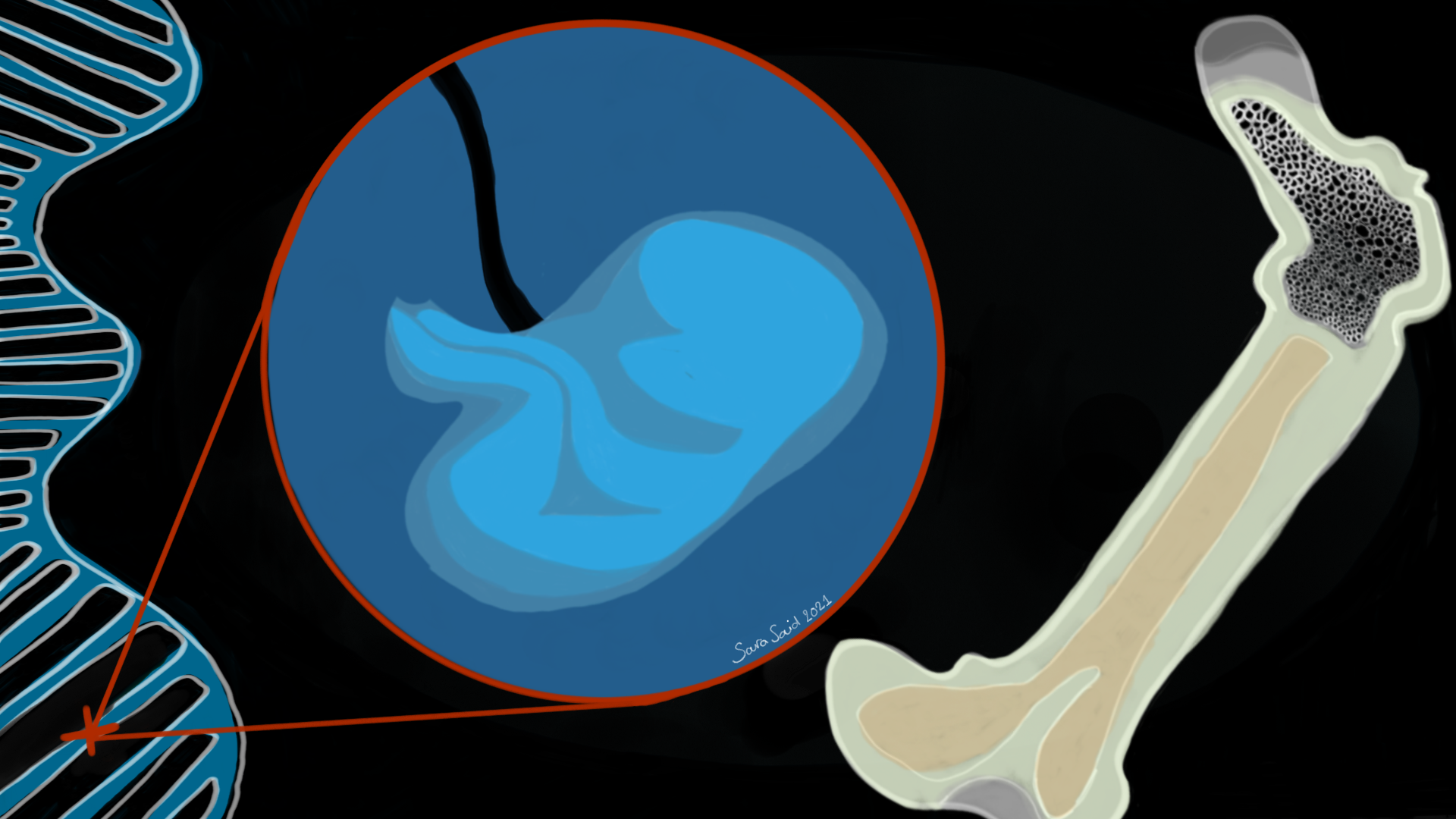 Fibrodysplasia Ossificans Progressiva: bone formation outside the ...